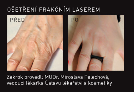 frakční laser ruce