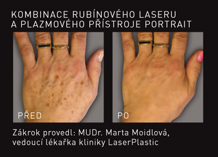 rubínový laser plazmový přístroj portrait