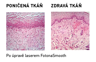 operativní řešení inkontinence